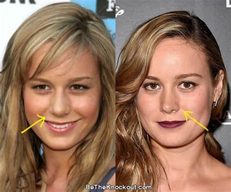 Brie Larson Plastic Surgery Comparison Photos